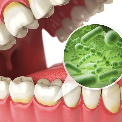 Animation of smile with bacteria