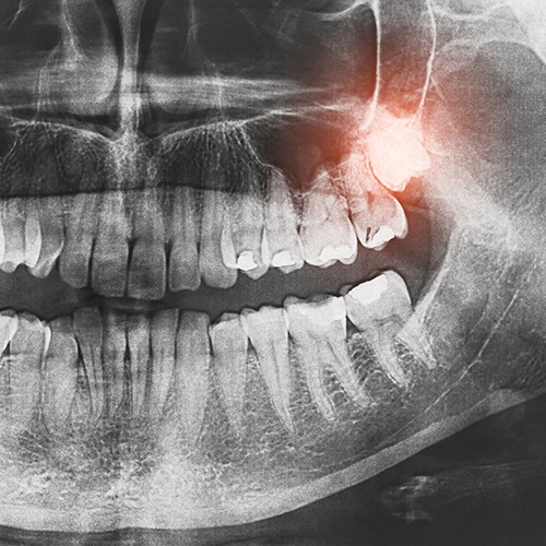 X-Ray of impacted wisdom tooth