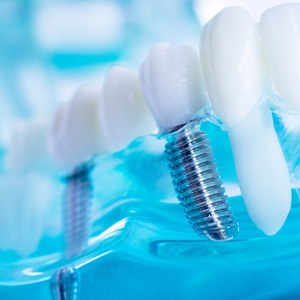 Closeup of model dental bridge attached to implants in clear lower jaw base
