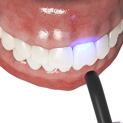 Illustration of the process of dental bonding in North Dallas, TX