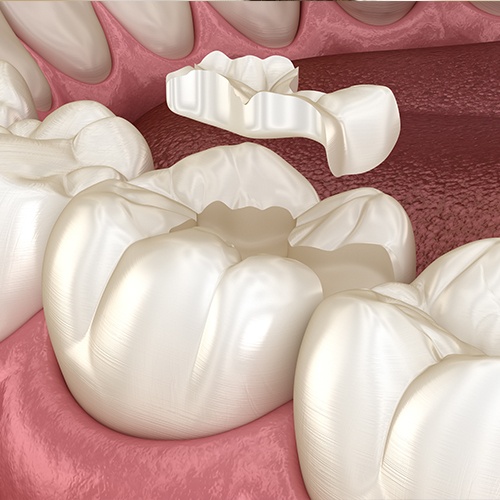 Closeup of tooth-colored restoration placement