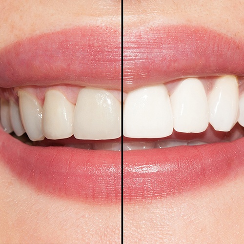 Smile before and after teeth whitening