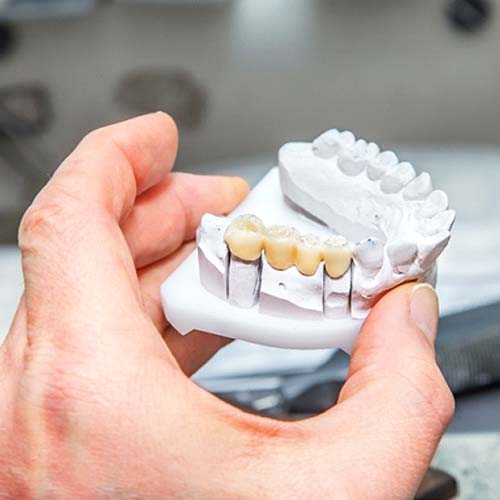 Model of dental bridge in Dallas