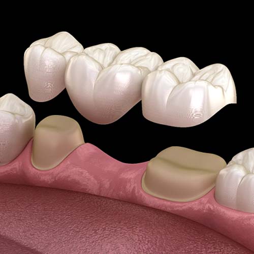 Digital illustration of dental bridge in Dallas