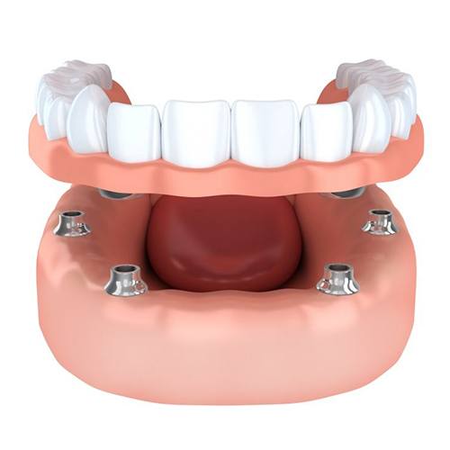 diagram of implant-retained dentures