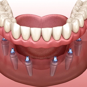 Digital illustration of dental implant dentures in Dallas