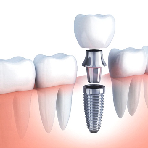 diagram of dental implant, abutment, and crown