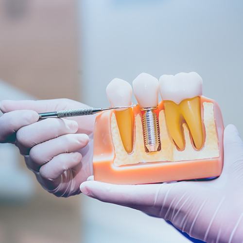 Dentist pointing to model of dental implant