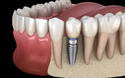 Animation of implant supported dental crown