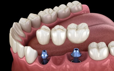 Animation of implant supported fixed bridge