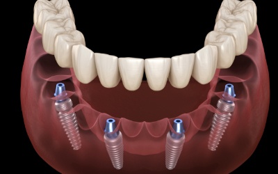 Animation of implant supported denture