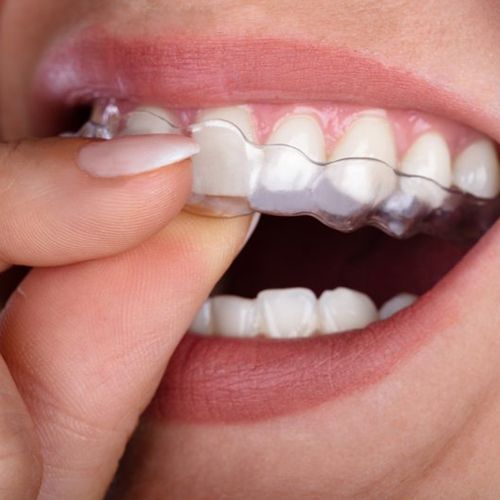 close up of person placing aligner in their mouth 