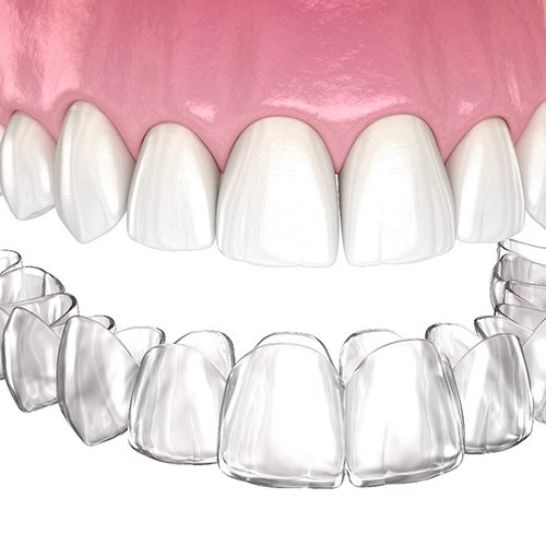 A digital image of an Invisalign aligner sitting beneath the top row of teeth in preparation for placement 
