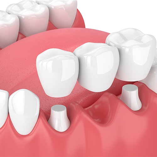 Animation of implant supported fixed bridge