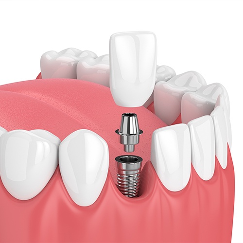 Animation of dental implant placement process