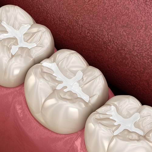 Animation of teeth with tooth-colored fillings