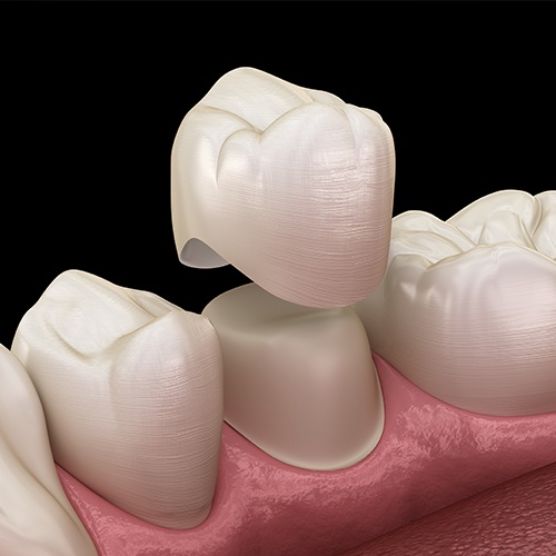 Animation of dental crown placement