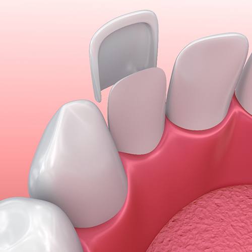 Diagram of how to place veneers in North Dallas