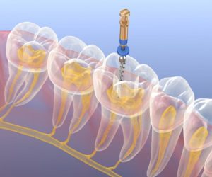 root canal 3d illustration 